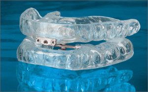 best dental sleep apnea mouth guard