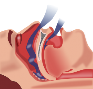 know what is obstructive sleep apnea